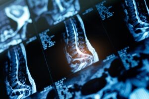 What are the Four Classifications of Spinal Cord Injuries