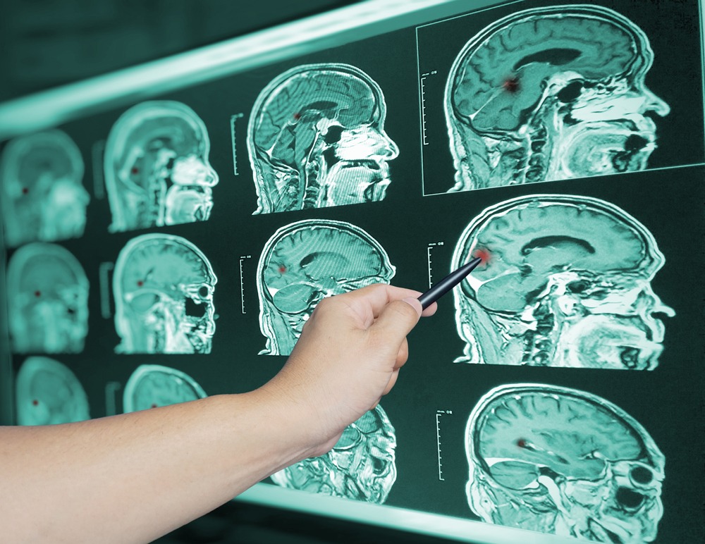 ¿Cuánto se puede demandar por lesión y trauma en la cabeza?