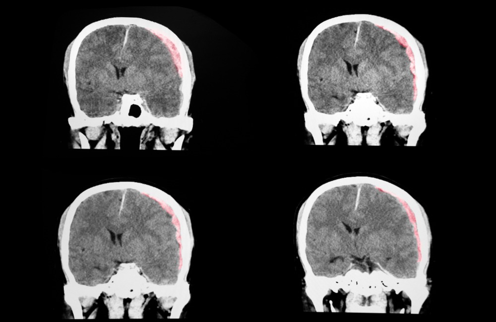 ¿Cuánto se puede demandar por daño cerebral en Texas?